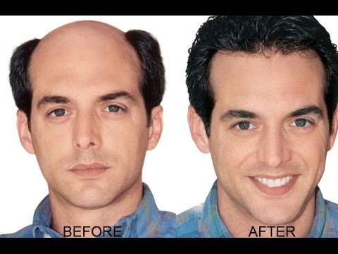 can hair regrow on the shiny part of the scalp